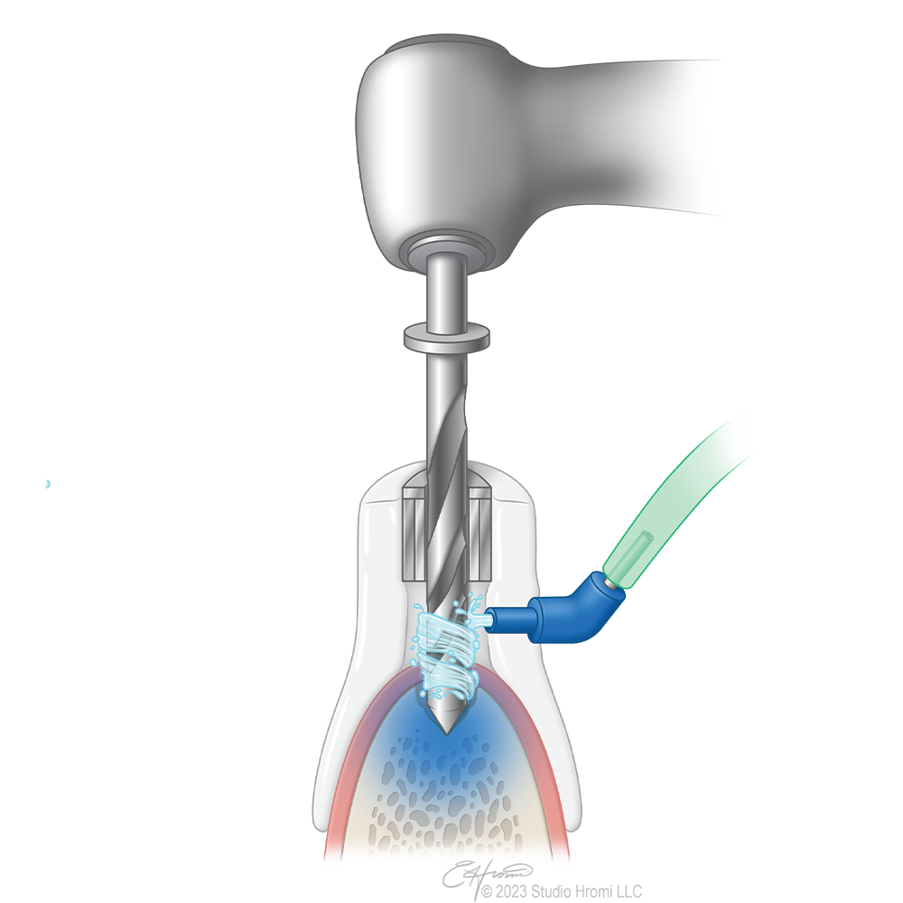 IrriGUIDE Adapter Refill Kit